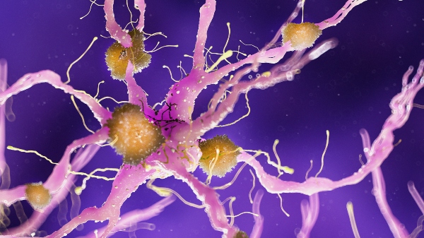 Amyloidplaques auf einer Alzheimernervenzelle